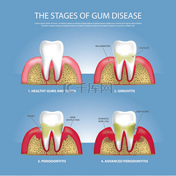 假牙清洁图片_人类牙齿阶段的牙龈疾病媒介图解