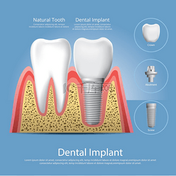 牙齿护理素材图片_人类的牙齿和牙种植体矢量图