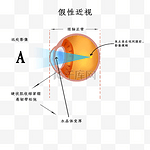 假性近视视网膜眼球