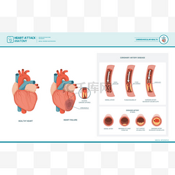 心脏病和动脉粥样硬化的医学插图