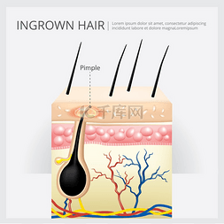 皮肤病学图片_向内生长的头发结构矢量图