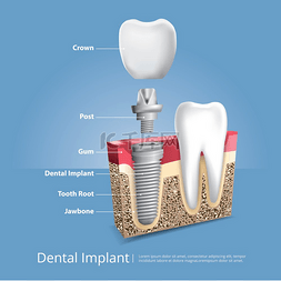 口腔护理矢量图图片_人类的牙齿和牙种植体矢量图