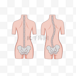 腰椎穿刺图片_脊柱侧弯矫正腰椎