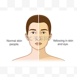 手绘皮肤问题图片_正常人与眼睛和皮肤泛黄的比较。