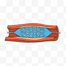 颈动脉硬化示意图图片_心脏病学扩张的球囊和动脉支架插