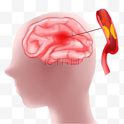 大脑储备图片_大脑生病中风