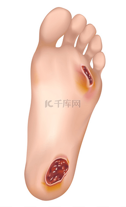 heel图片_Diabetic foot.