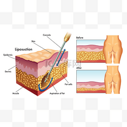 人类脂肪抽吸术的机制