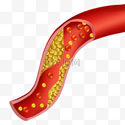 人体血管图图片_血管堵塞动脉胆固醇阻塞