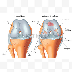 膝盖卡通图片_人类的膝盖关节