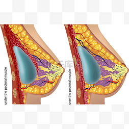 组织结构图表图片_整形外科的乳房植入物。矢量