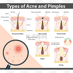 类型的痤疮和粉刺，矢量图
