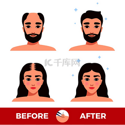 男人和女人在头发移植前后的白色