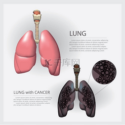 肺部细节和肺癌症载体插图