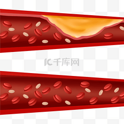 血管疏通图片_血管堵塞动脉胆固醇阻塞
