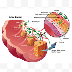 大肠癌图片_大肠癌