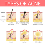 人类不同类型痤疮的医学病媒插图 