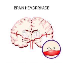 脑中风种类图片_脑出血。中风和大脑的内部出血.