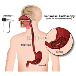 内窥镜png图片_经鼻内窥镜医学媒介例证在白色背