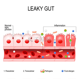 漏水的肠子。肠道内的细胞紧紧地