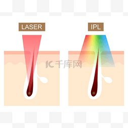 激光和IPL (强脉冲光)脱毛差异.护