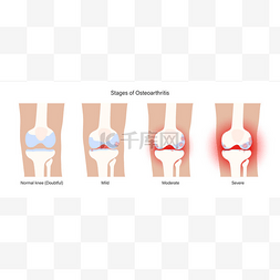 关节炎海报图片_膝关节关节炎