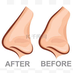 隆胸前后对比图片_鼻子在前后隆鼻 （整形外科矢量