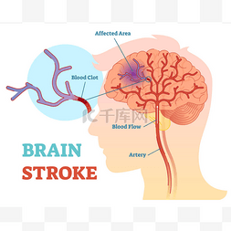 卒中系统图片_脑卒中解剖向量图解图, 方案 