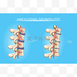 脊柱关节关节炎症状向量图表