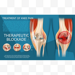 膝关节疼痛的真实图解治疗