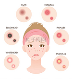 粉刺的类型和女性面部的图解。白头、黑头、丘疹和脓肿。美容美发概念