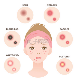 粉刺的类型和女性面部的图解。白