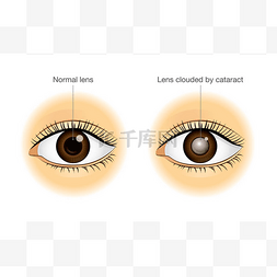 正常发挥图片_正常的眼睛和镜头蒙蔽白内障.