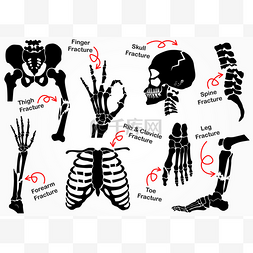 骨裂图片_设置骨裂图标 （ Pelvic， 臀部， 