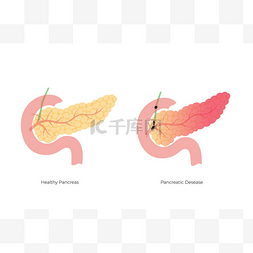 胰腺炎图片_胰腺的向量分离图例