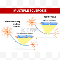 多发性硬化图片_受多发性硬化症的神经
