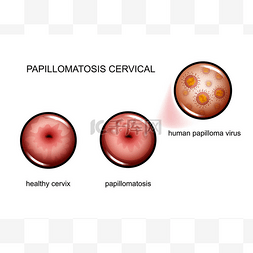 宫颈癌炎症图片_宫颈性皮瘤病。人类皮宗瘤病毒