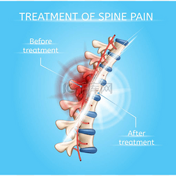脊柱疼痛现实向量图的治疗