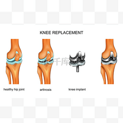 全膝关节置换的矢量图解