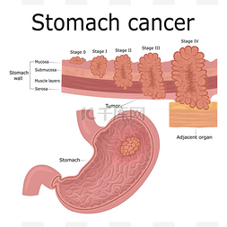 肿瘤侵袭图片_五发展的阶段肿瘤疾病-胃的癌症