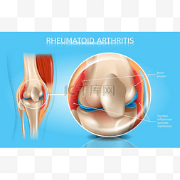 关节炎海报图片_类风湿关节炎矢量医疗方案