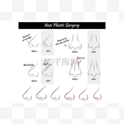 鼻子整形图片_整形手术。鼻子. 