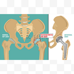 关节的疼痛图片_髋关节骨关节炎海报