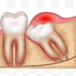 智齿爆发问题发炎牙龈说明解剖
