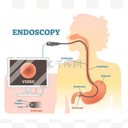 体制监测图片_内窥镜解剖向量图解, 医疗方案.