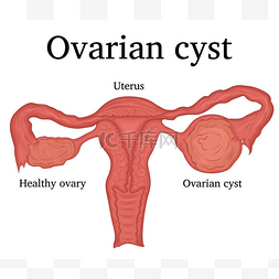 卵巢附件图片_卵巢囊肿的插图