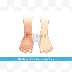肿胀图片_肿胀的脚和脚踝.