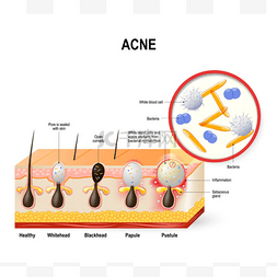 皮肤细菌图片_寻常痤疮或红色丘疹.