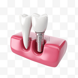 大号磨牙棒图片_3d 牙龈与牙种植体隔离 3d 渲染插