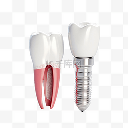 磨牙棒矢量素材图片_牙种植体结构人类牙齿和牙种植体